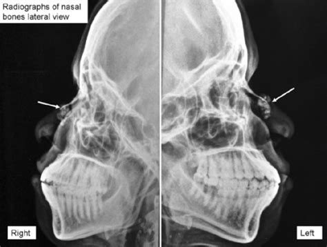 nose stl x ray meaning|Diagnostic X.